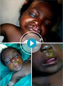 Baby's_before_and_after_at_Camp_Eden_Hospital_Gboko
